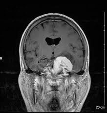 Not my brain, but similar tumor, opposite side.
